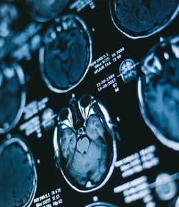 Traumatic Brain Injury